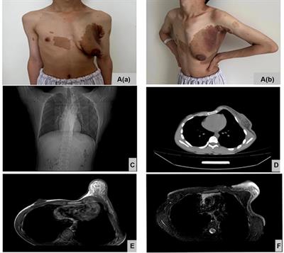 Unilateral severe gynecomastia in a 14 year-old adolescent with neurofibromatosis type 1 undergoing endoscopic mastectomy: a case report